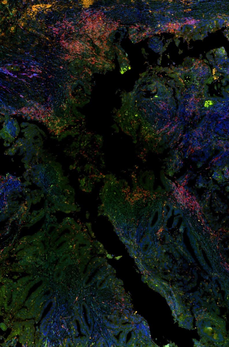 Five-channel immunofluorescence resolving multiple markers across a single tissue section.